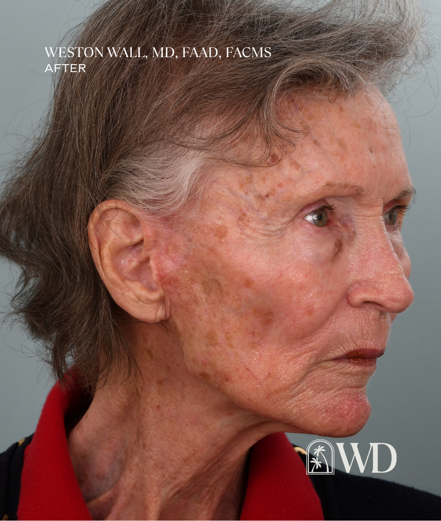 After facelift
