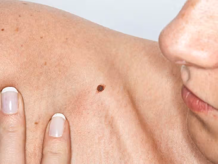 Identifying and treating skin cancer spots early