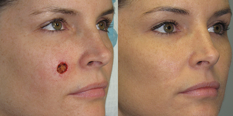 Basal Cell Skin Cancer Removal