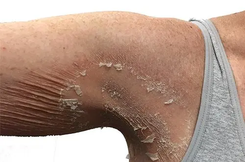 armpit skin peeling