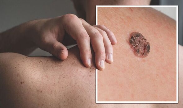 can skin cancer itch