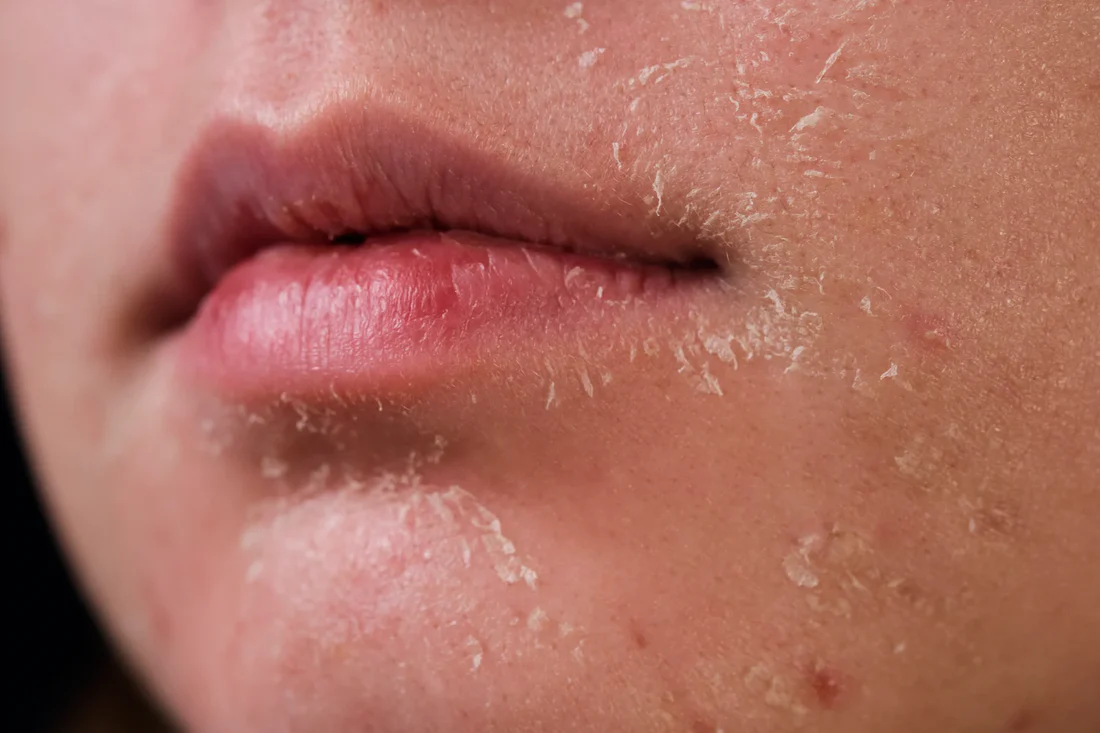 cancer skin peeling