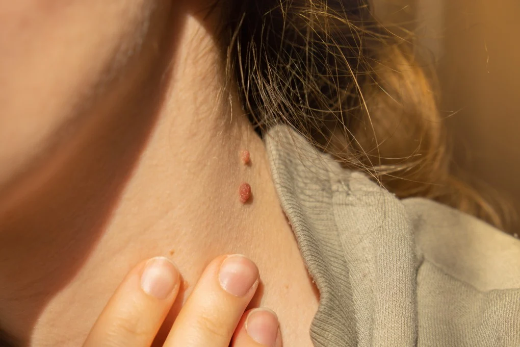 cancer spots on skin