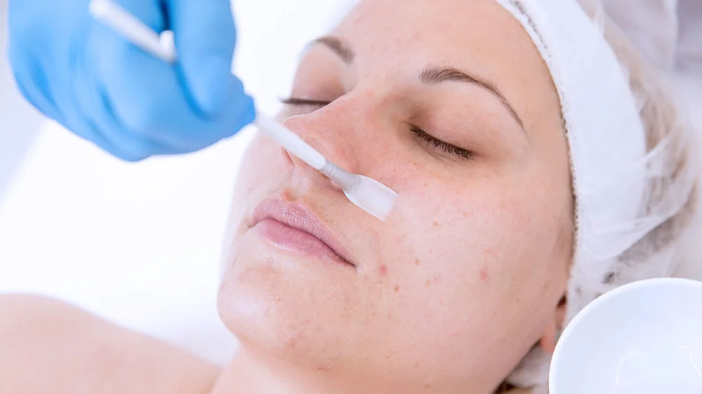 chemical peel for skin cancer