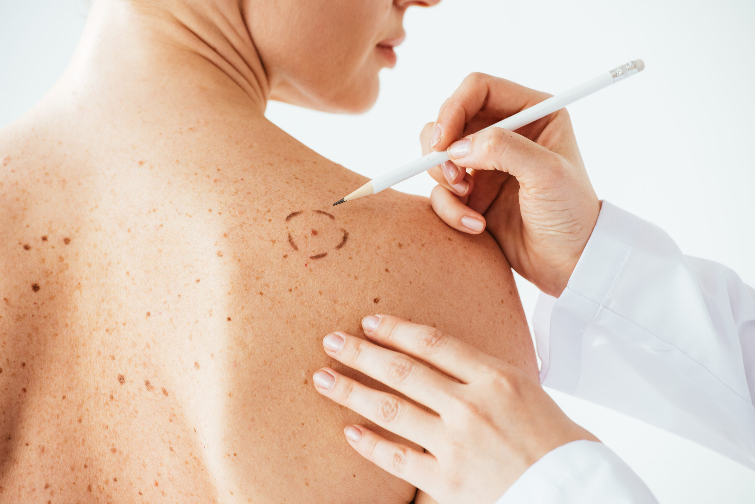 dermatologist for skin cancer