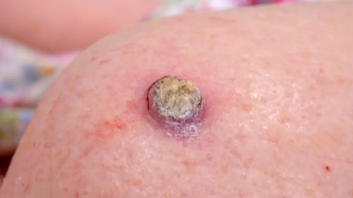 early stage skin cancer