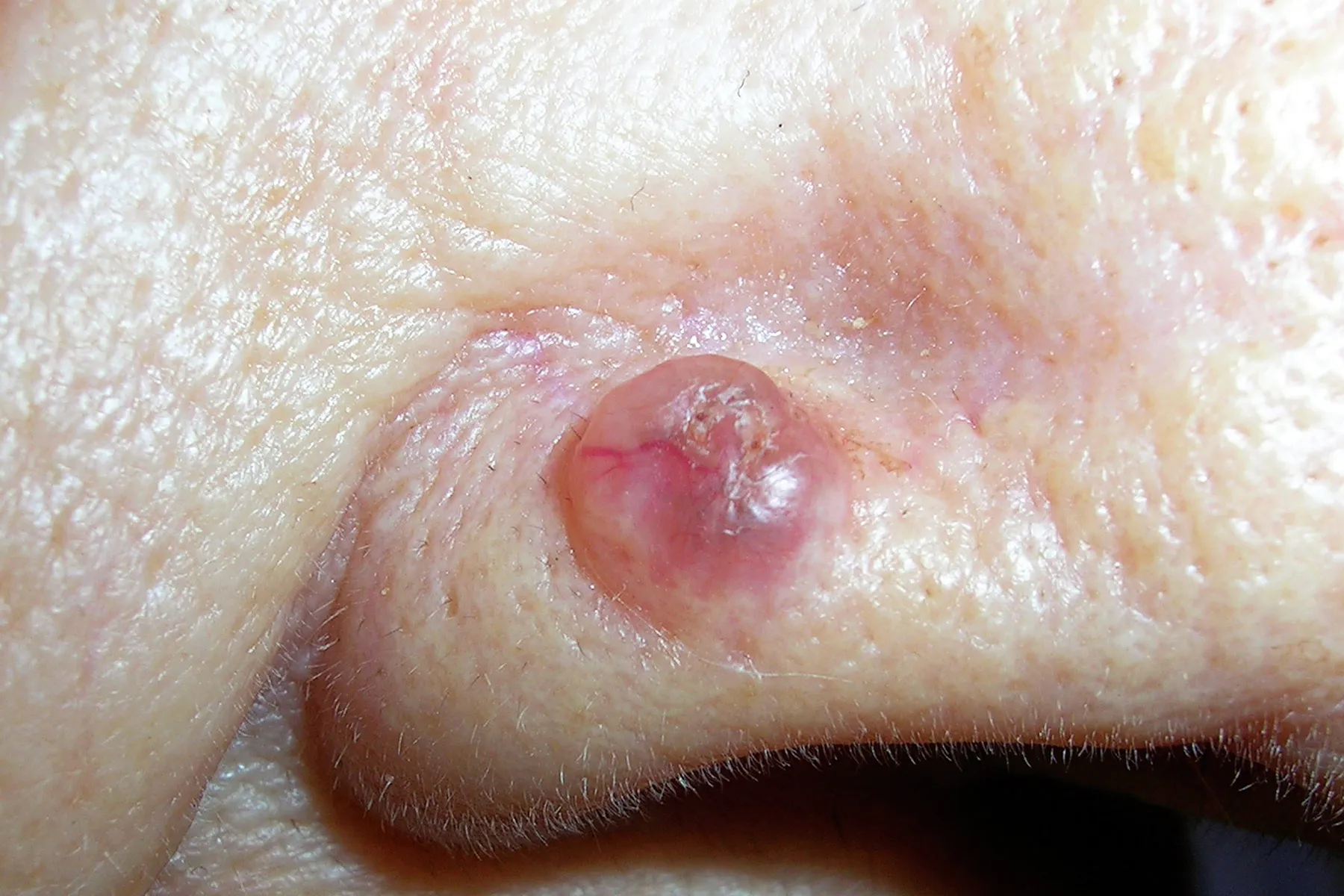 clear bump skin cancer