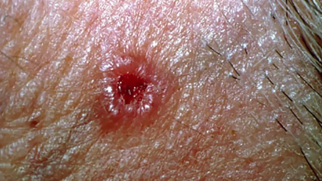skin cancer clear bump