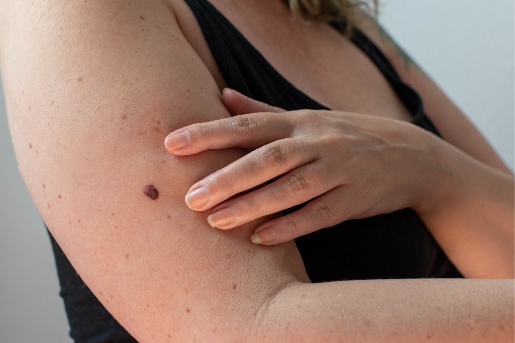 melanoma skin cancer
