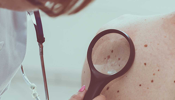 skin cancer face removal