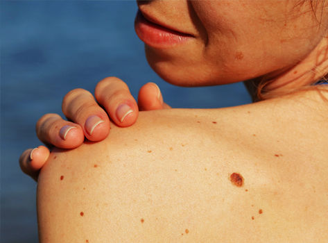 Skin Cancer Signs