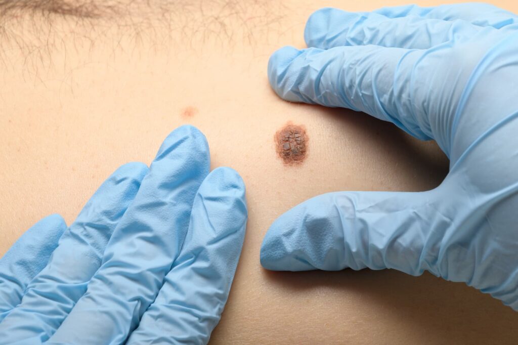 Melanoma Skin Cancer Treatment