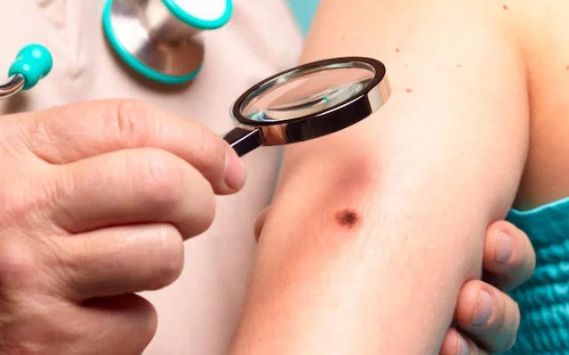 Melanoma Skin Cancer Treatment