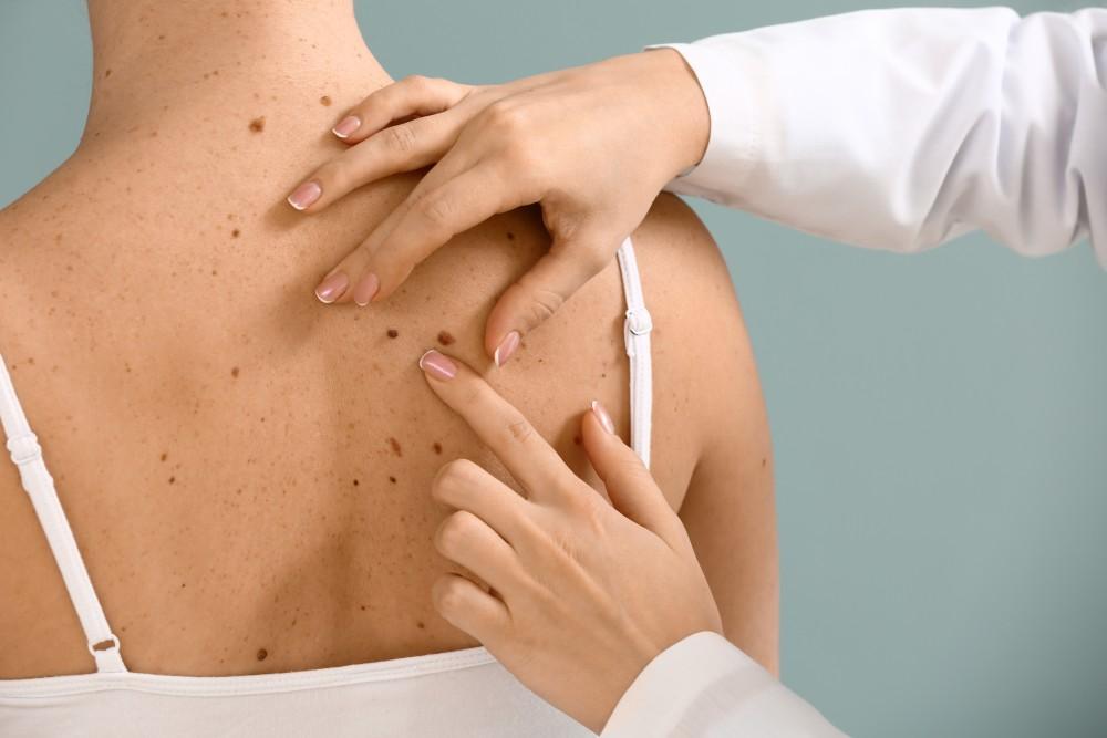 Removal of Skin Cancer