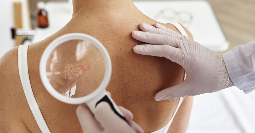 Treatments for Skin Cancer
