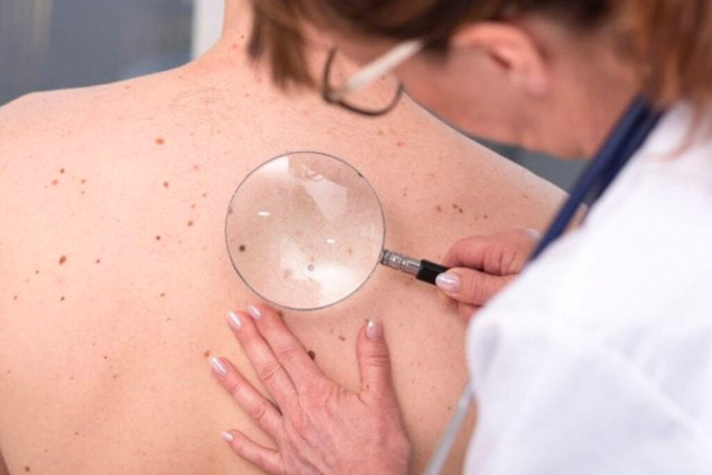 Melanoma Skin Cancer Removal