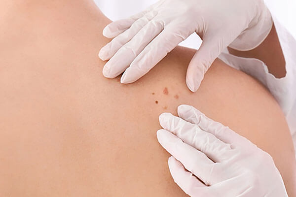 Treatment for Skin Cancer