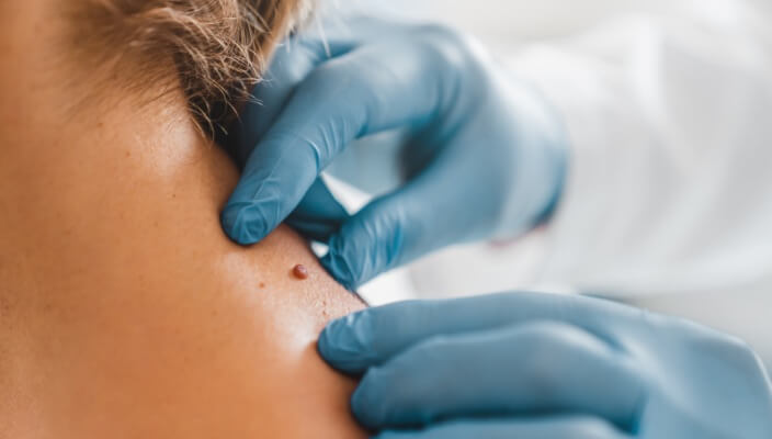 Treatment for Skin Cancer