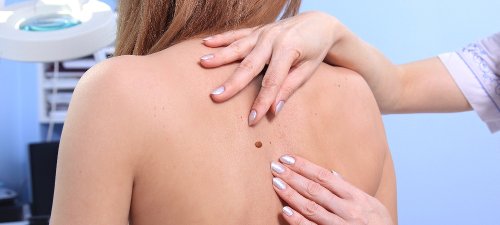 Skin Cancer Signs