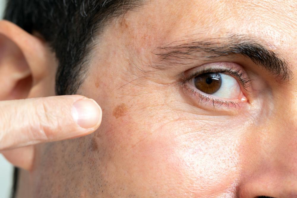 Skin Cancer Melanoma Treatment