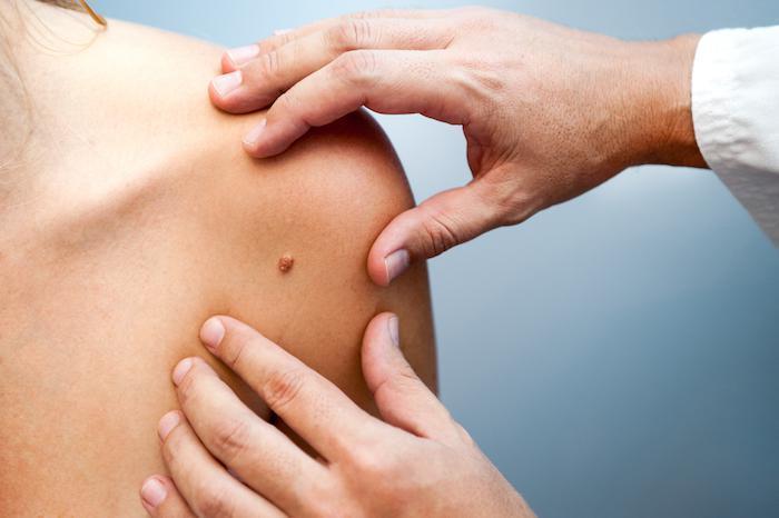 skin cancer melanoma treatment