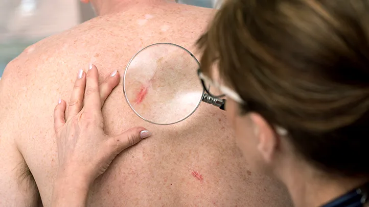Treatments for Skin Cancer