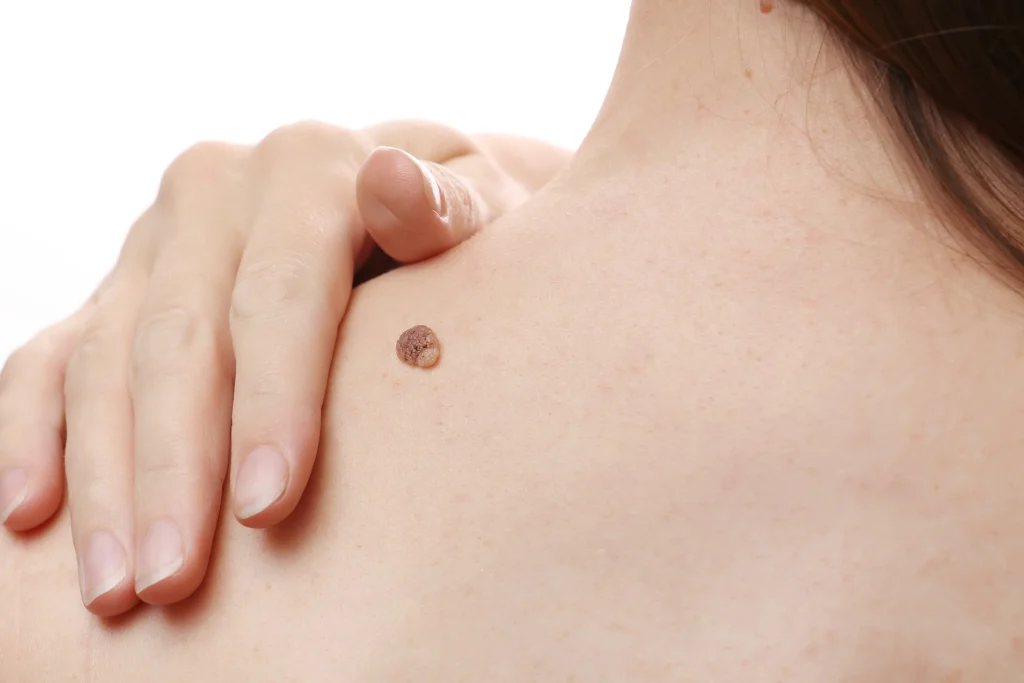 Melanoma Skin Cancer Removal