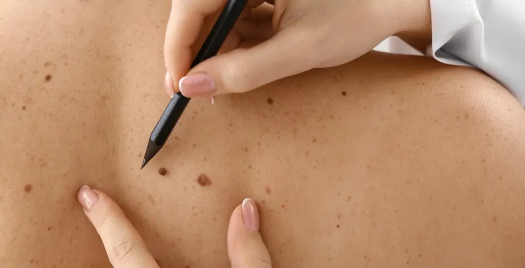Melanoma Skin Cancer Removal