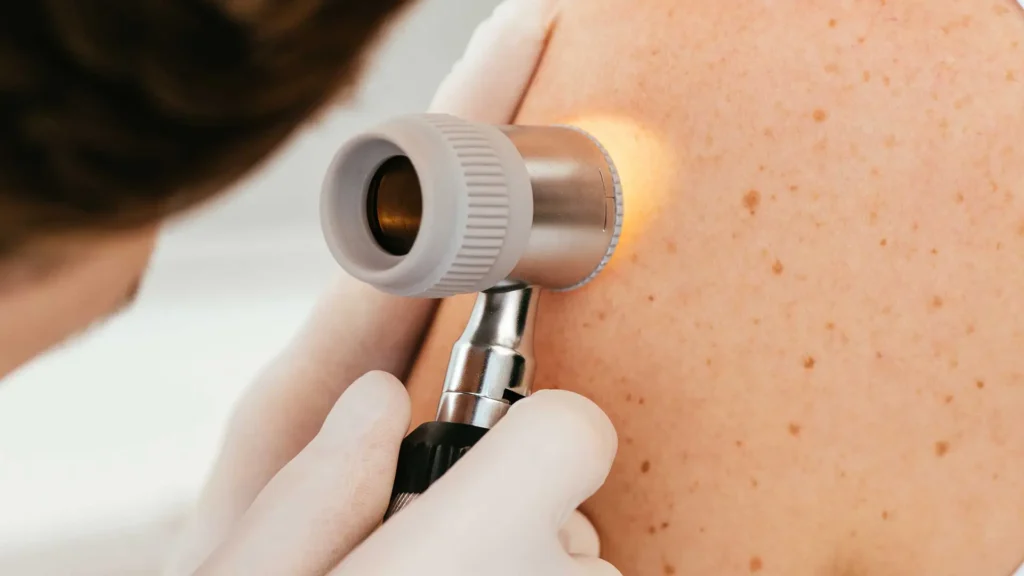 Skin Cancer Alternative Treatment