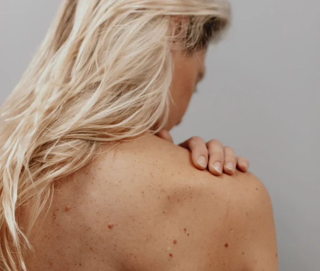 Skin Cancer Alternative Treatment