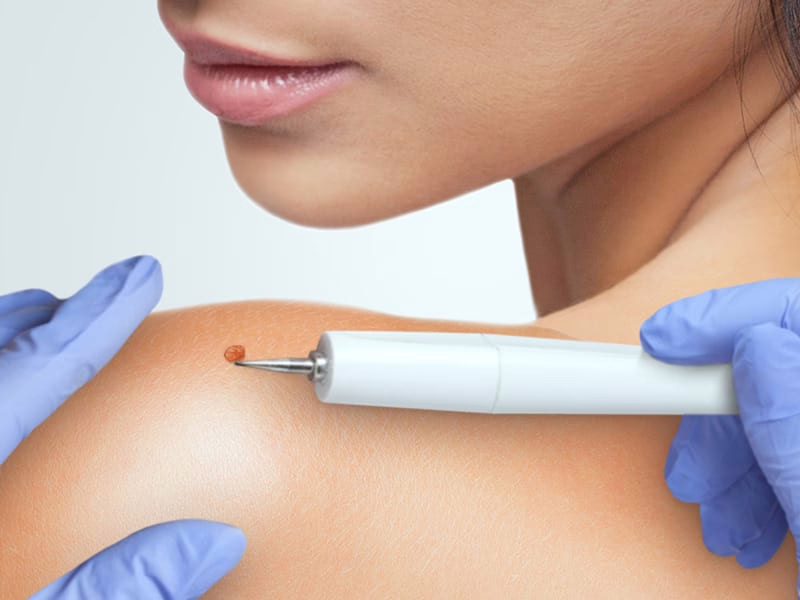 Skin Cancer Treatment St. Petersburg