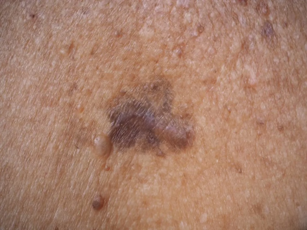 can skin cancer kill you