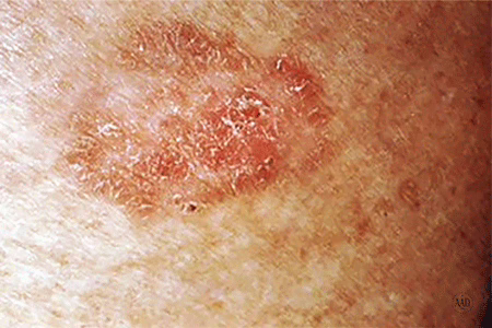 Peeling Skin Cancer