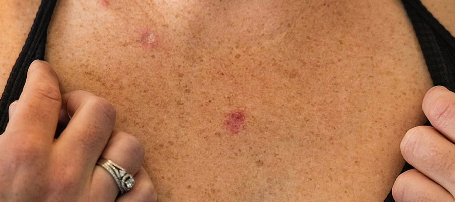 Skin Cancer Removal Surgery