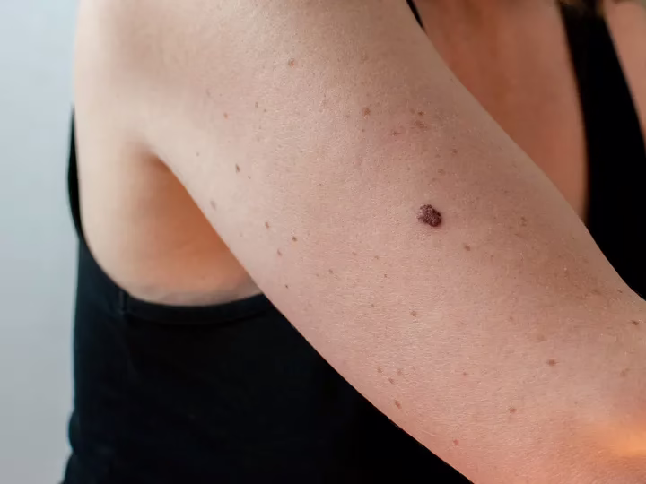 Skin Cancer Types on Face