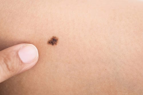 Is Skin Cancer Deadly