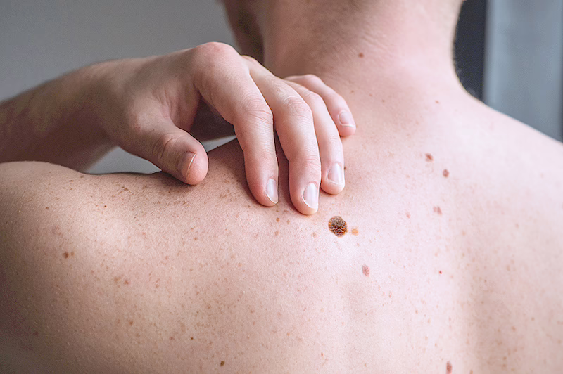 Is Skin Cancer Deadly