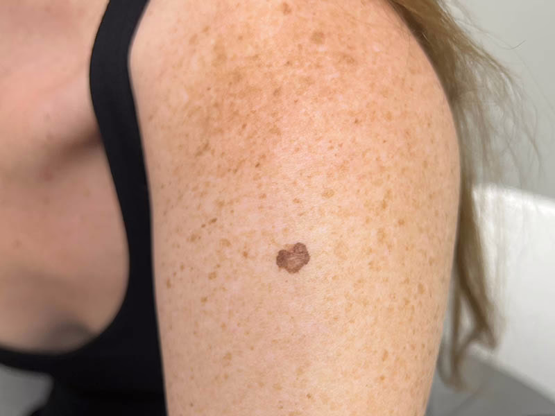 Is Skin Cancer Deadly