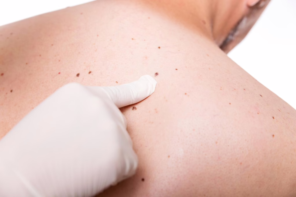 Skin Cancer Early Detection